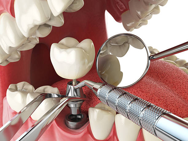 Best Emergency Broken Tooth Repair in Copperopolis, CA